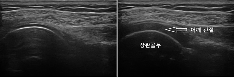 수압팽창술 전 유착된 어깨 관절(좌) 수압팽창술 후 팽창된 어깨 관절(우)