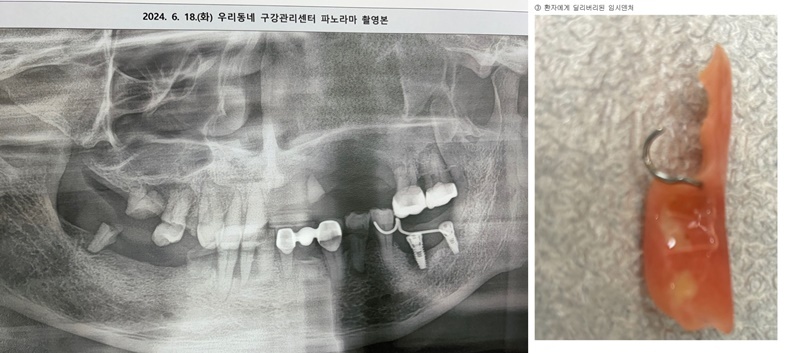 A구보건소 측이 제보한 환자의 방사선진단촬영본과 환자가 T치과에서 치료를 받았다는 부분틀니 모습.