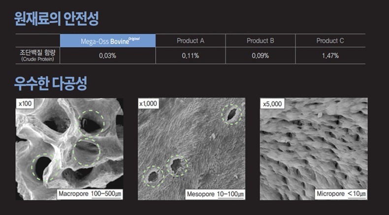 안전한 청정지역 뉴질랜드산 소뼈의 100% 해면골을 이용, 메가젠만의 제조공법으로 불순물을 철저히 제거해 안전성을 강화했다. 다양한 크기의 기공들이 존재하는 다공성 구조로써 상호연결성이 우수해 이식재 내로 혈액 투입이 용이해 골 형성 세포의 부착 및 증식을 촉진한다.