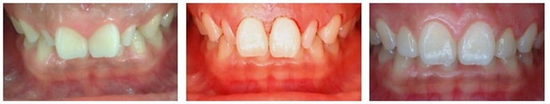 잇몸절제술(Gingivectomy)