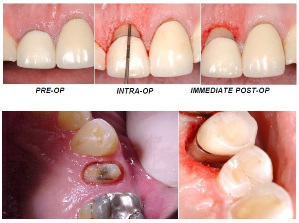 크라운 렝스닝 시술(Crown Lengthening)