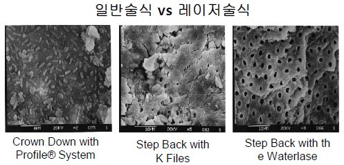 근관치료