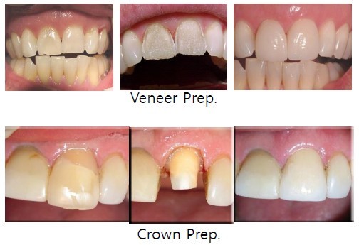 비니어 제거(Veneer & Zr Crown Debonding)