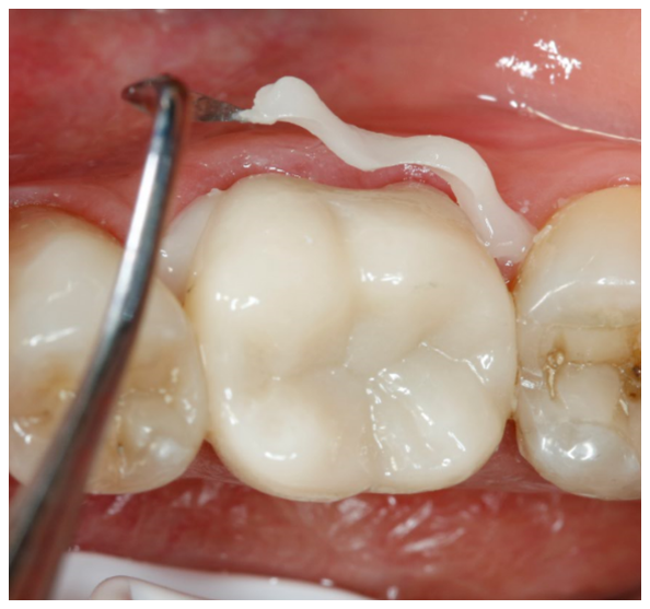 Photo : courtesy of Dr. Gunnar Reich, Germany