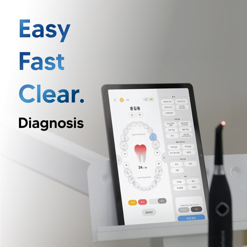 힐덴스, 접촉식 충치진단기 '스마투스' 출시 - 뉴스 썸네일 이미지